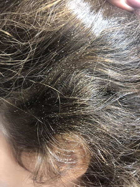 Traitement anti poux TeamYoopi Val dOise Avant beaucoup de lentes